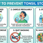 How to Prevent Tonsil Stones: Effective Tips